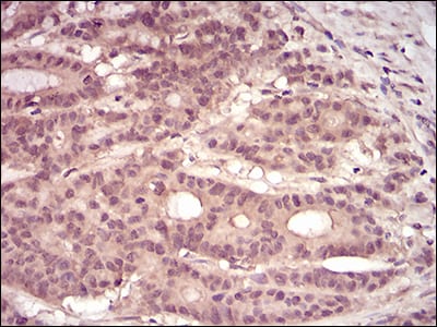 Figure 5: Immunohistochemical analysis of paraffin-embedded colon cancer tissues using PKN1 mouse mAb with DAB staining.