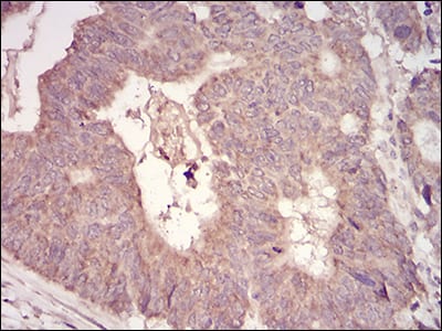 Figure 3: Immunohistochemical analysis of paraffin-embedded rectum cancer tissues using MuRF1 mouse mAb with DAB staining.