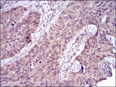 Figure 5: Immunohistochemical analysis of paraffin-embedded cervical cancer tissues using CASP-7 mouse mAb with DAB staining.