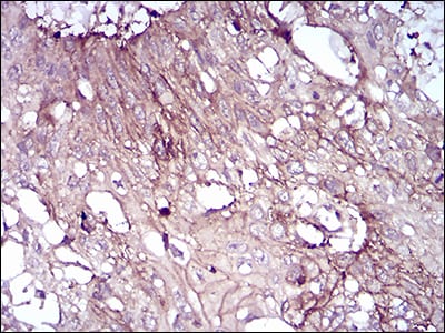 Figure 5: Immunohistochemical analysis of paraffin-embedded esophageal cancer tissues using CD6 mouse mAb with DAB staining.