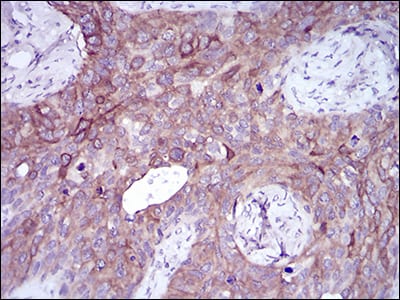 Figure 6: Immunohistochemical analysis of paraffin-embedded cervical cancer tissues using SNAI2 mouse mAb with DAB staining.