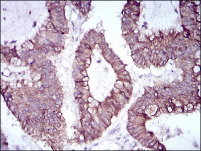 Figure 7: Immunohistochemical analysis of paraffin-embedded colon cancer tissues using SNAI2 mouse mAb with DAB staining.