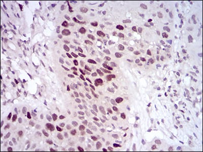 Figure 4: Immunohistochemical analysis of paraffin-embedded esophageal cancer tissues using HDAC10 mouse mAb with DAB staining.