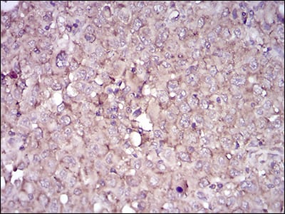 Figure 4: Immunohistochemical analysis of paraffin-embedded endometrial cancer tissues using CD38 mouse mAb with DAB staining.