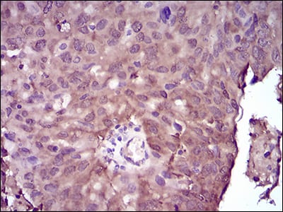 Figure 3: Immunohistochemical analysis of paraffin-embedded ovarian cancer tissues using NME2 mouse mAb with DAB staining.