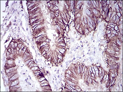 Figure 3: Immunohistochemical analysis of paraffin-embedded rectum cancer tissues using CDH17 mouse mAb with DAB staining.