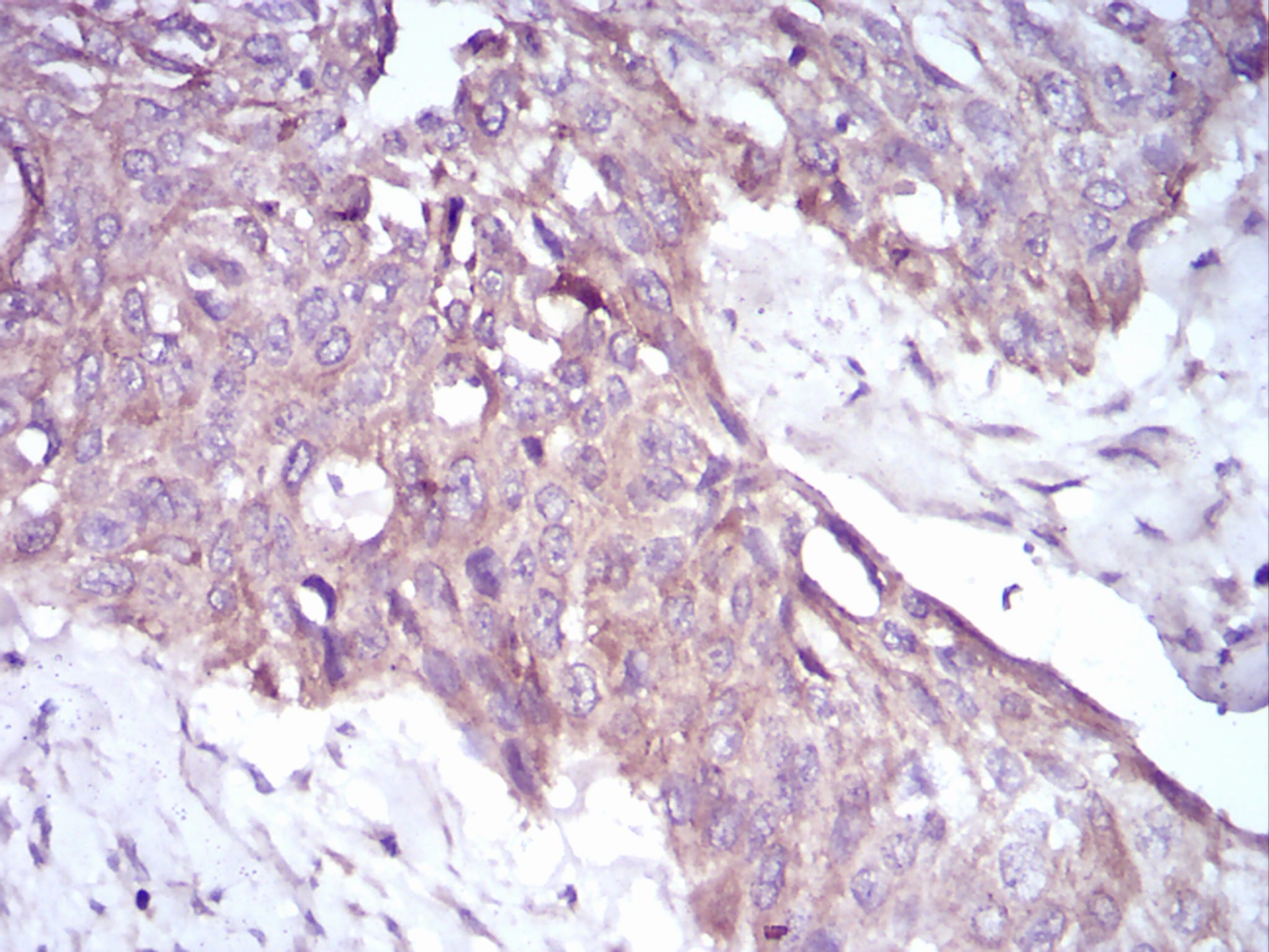 Figure 4: Immunohistochemical analysis of paraffin-embedded esophageal cancer tissues using PKHD1 Rat mAb with DAB staining.