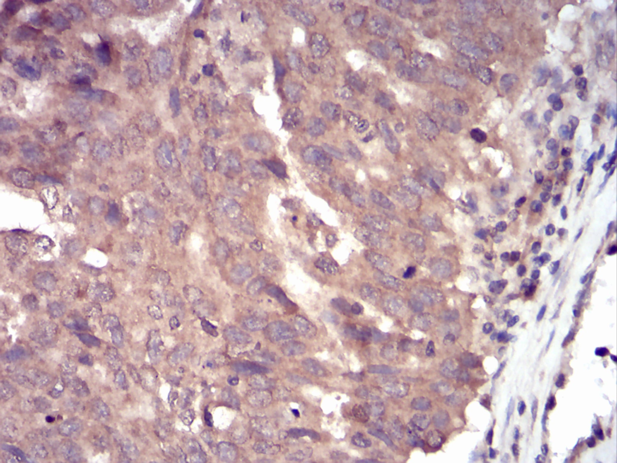 Figure 2: Immunohistochemical analysis of paraffin-embedded ovarian cancer tissues using SLINGSHOT-1L mouse mAb with DAB staining.