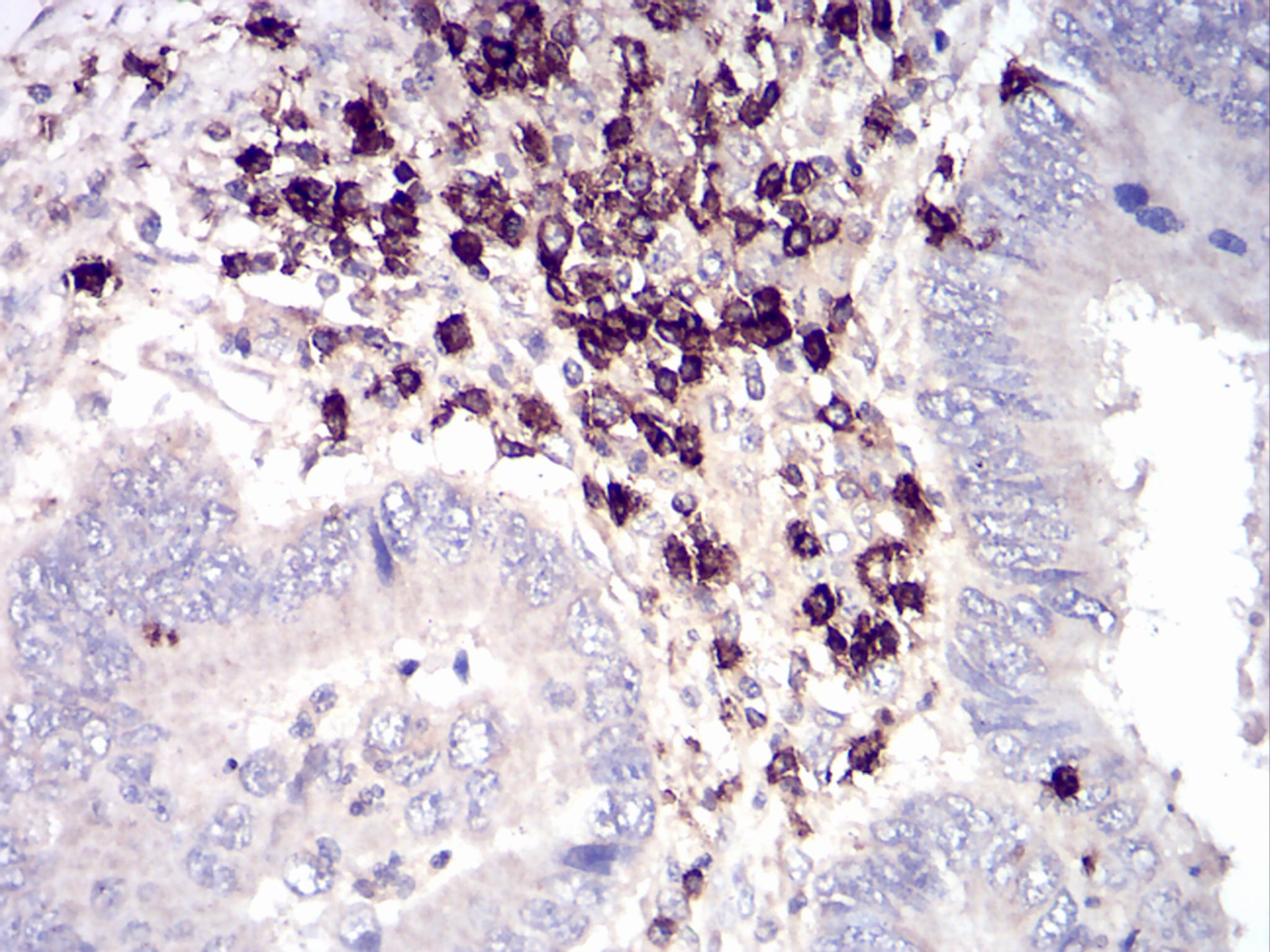 Figure 6: Immunohistochemical analysis of paraffin-embedded rectum cancer tissues using rectum cancer mouse mAb with DAB staining.