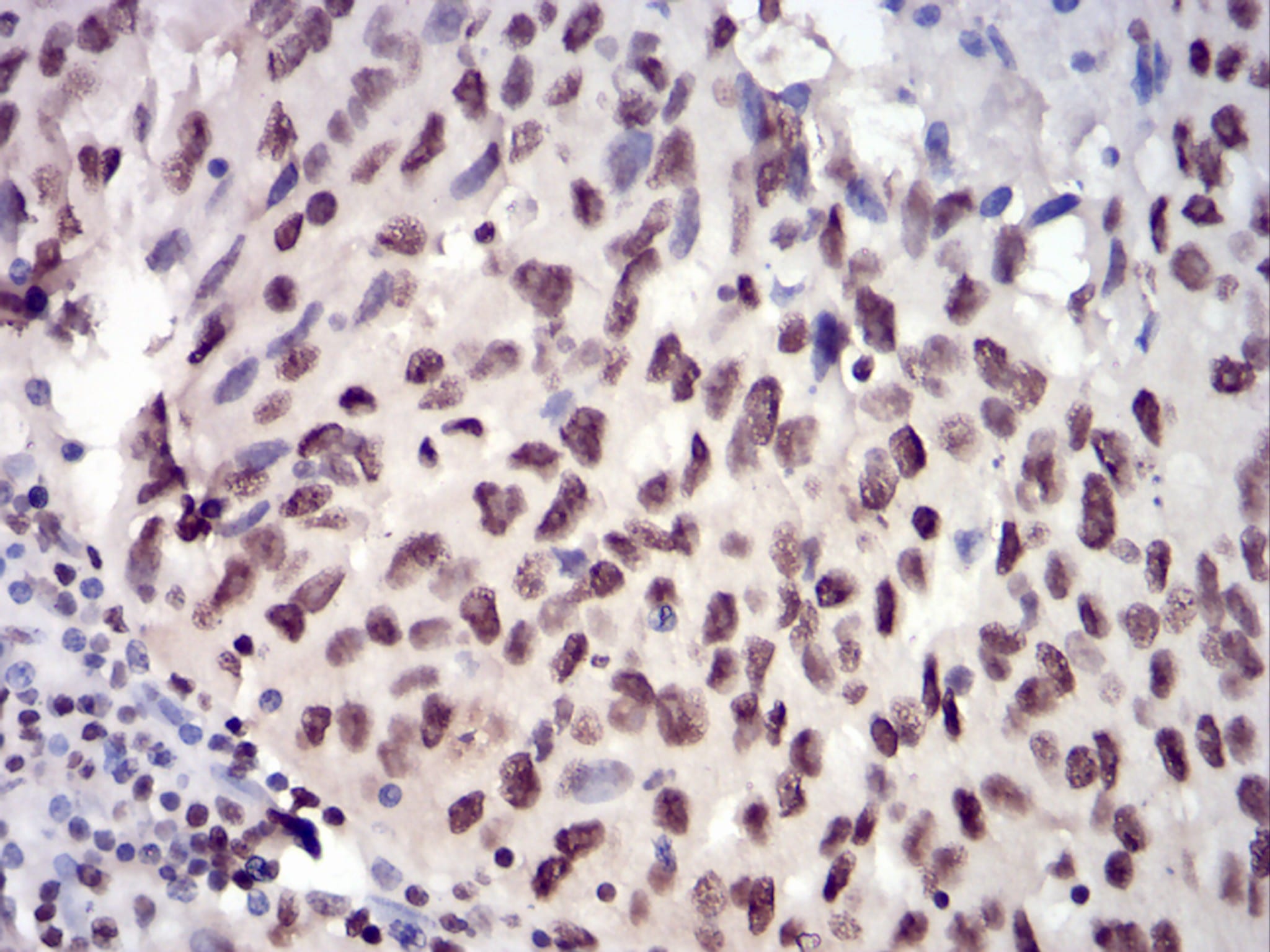 Figure 4: Immunohistochemical analysis of paraffin-embedded ovarian cancer tissues using JAK2 mouse mAb with DAB staining.