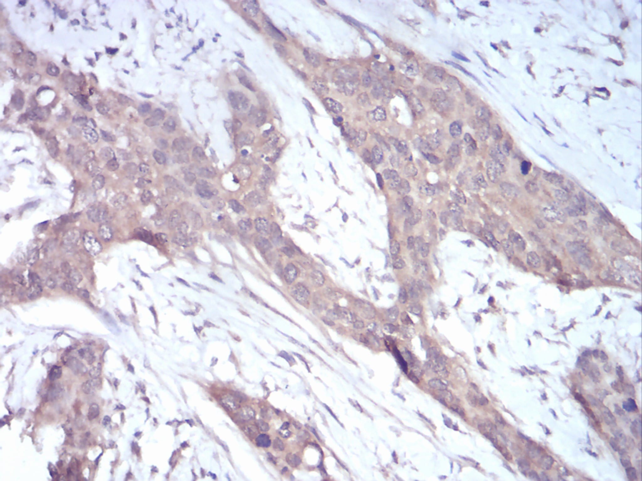 Figure 6:Immunohistochemical analysis of paraffin-embedded cervical cancer tissues using NOX4 mouse mAb with DAB staining.
