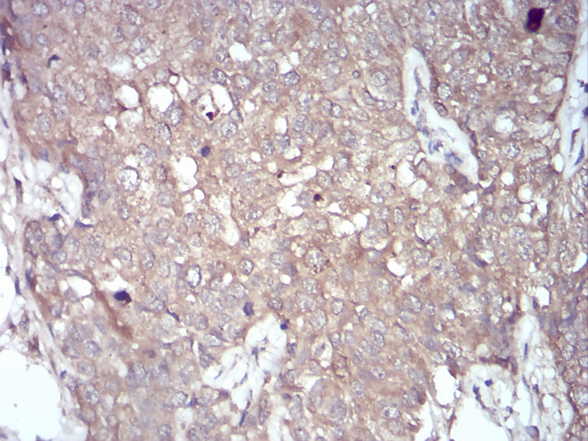 Figure 7:Immunohistochemical analysis of paraffin-embedded bladder cancer tissues using NOX4 mouse mAb with DAB staining.