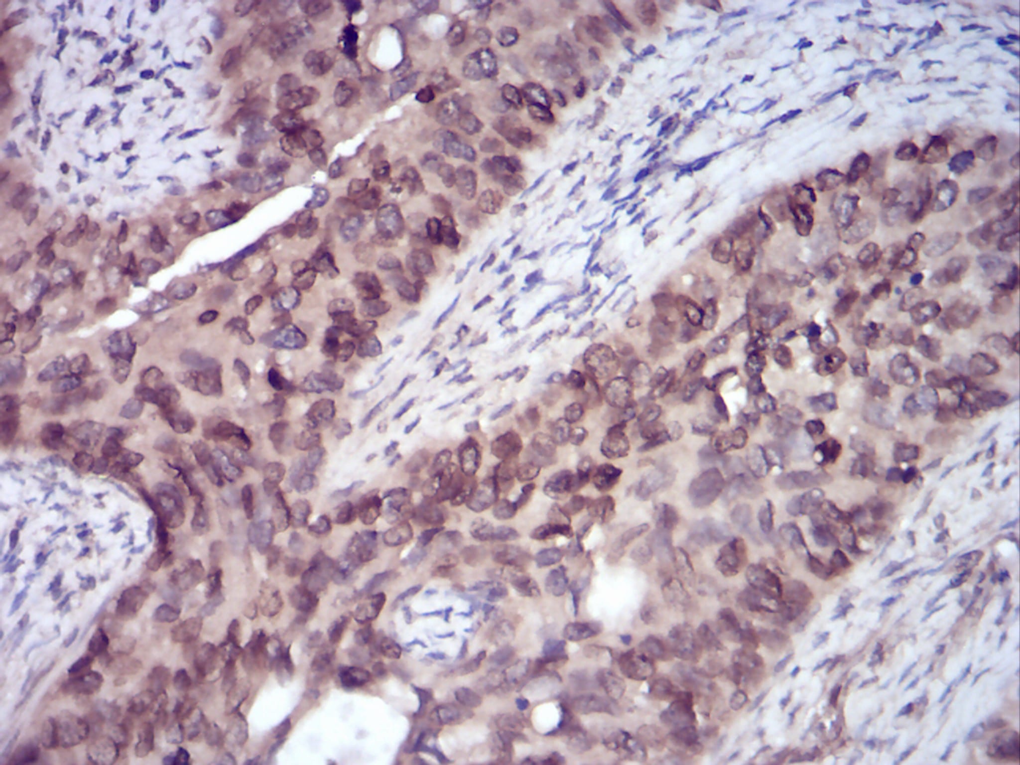 Figure 5:Immunohistochemical analysis of paraffin-embedded cervical cancer tissues using ERBB4 mouse mAb with DAB staining.