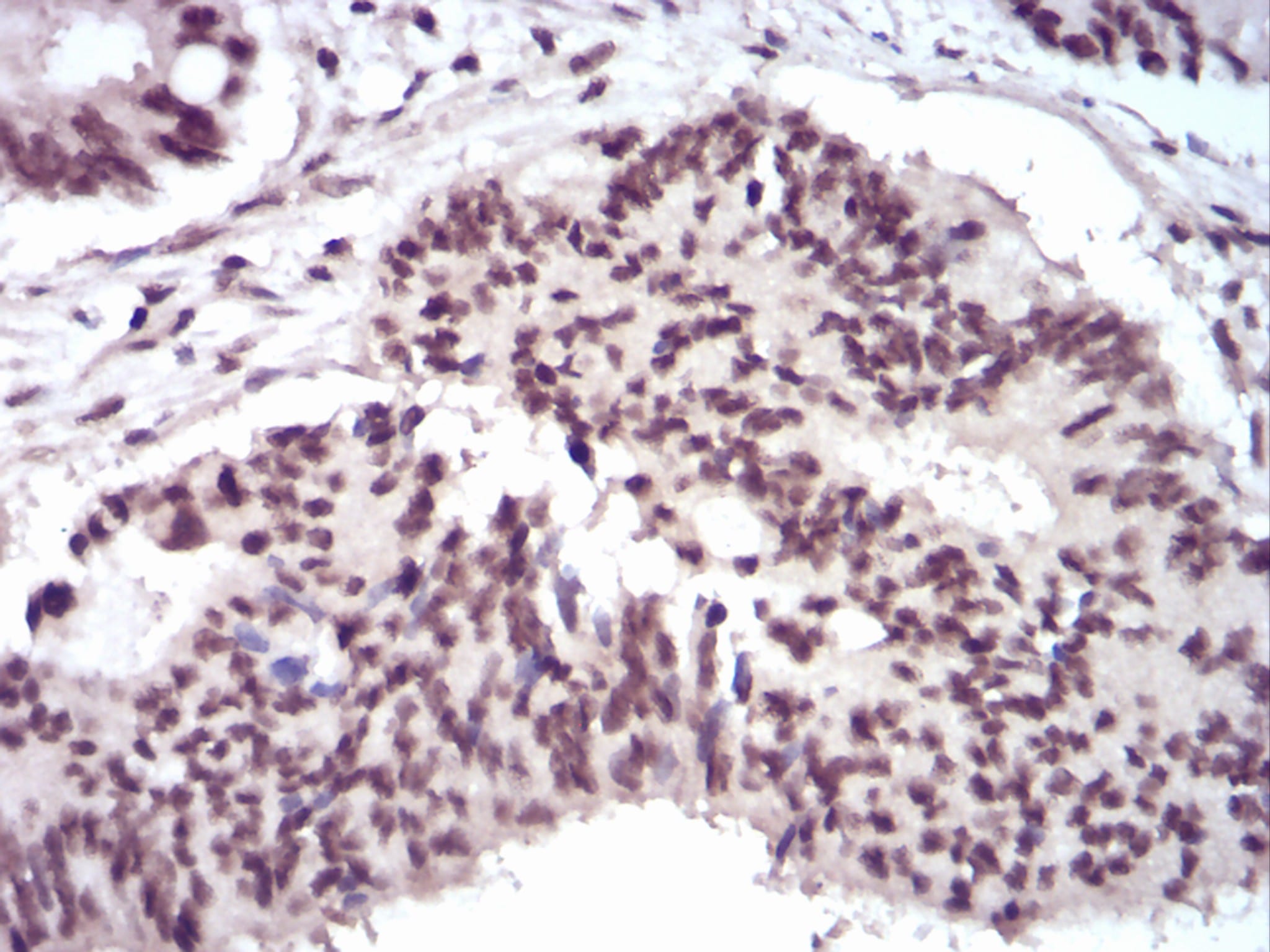 Figure 6:Immunohistochemical analysis of paraffin-embedded rectum cancer tissues using WTAP mouse mAb with DAB staining.