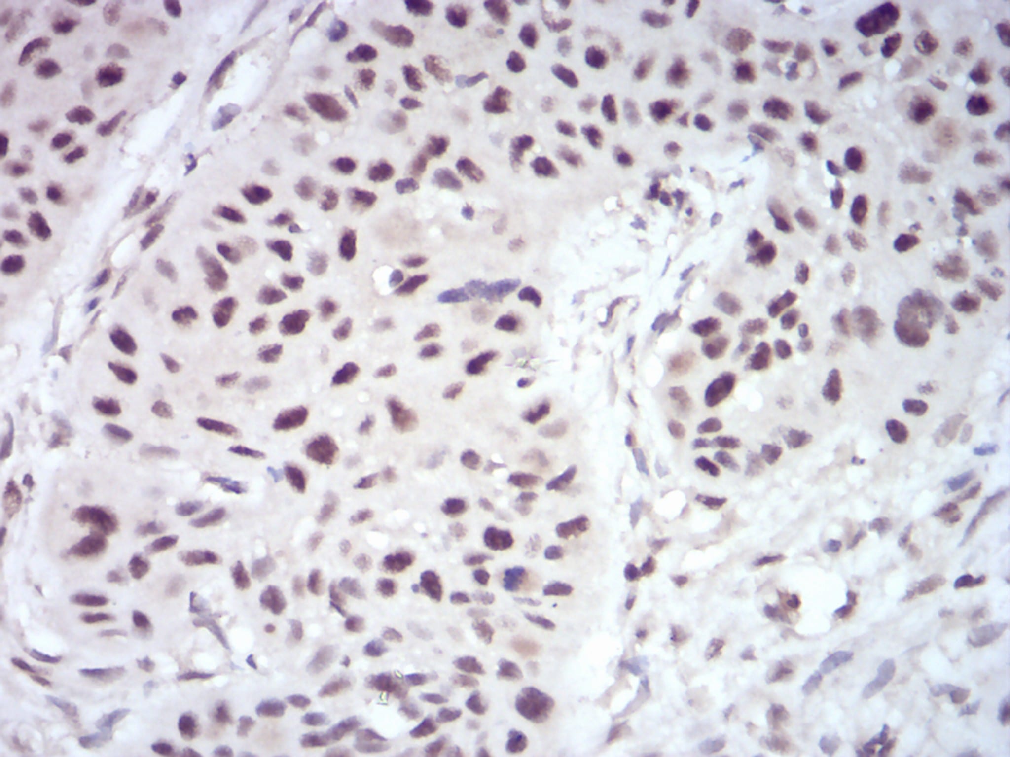 Figure 6:Immunohistochemical analysis of paraffin-embedded esophageal cancer tissues using WTAP mouse mAb with DAB staining.