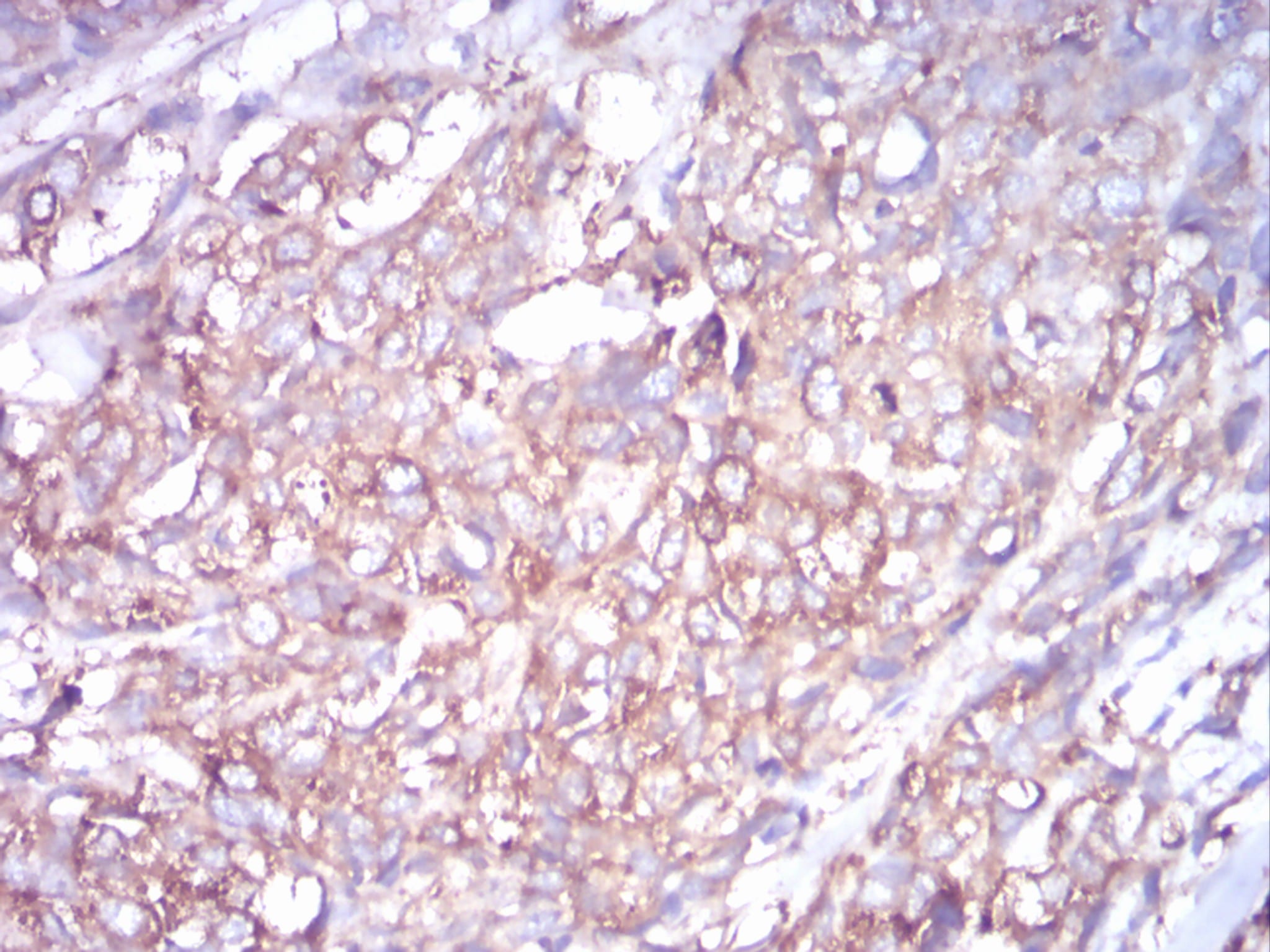 Figure 8:Immunohistochemical analysis of paraffin-embedded ovarian cancer tissues using TUBB1 mouse mAb with DAB staining.