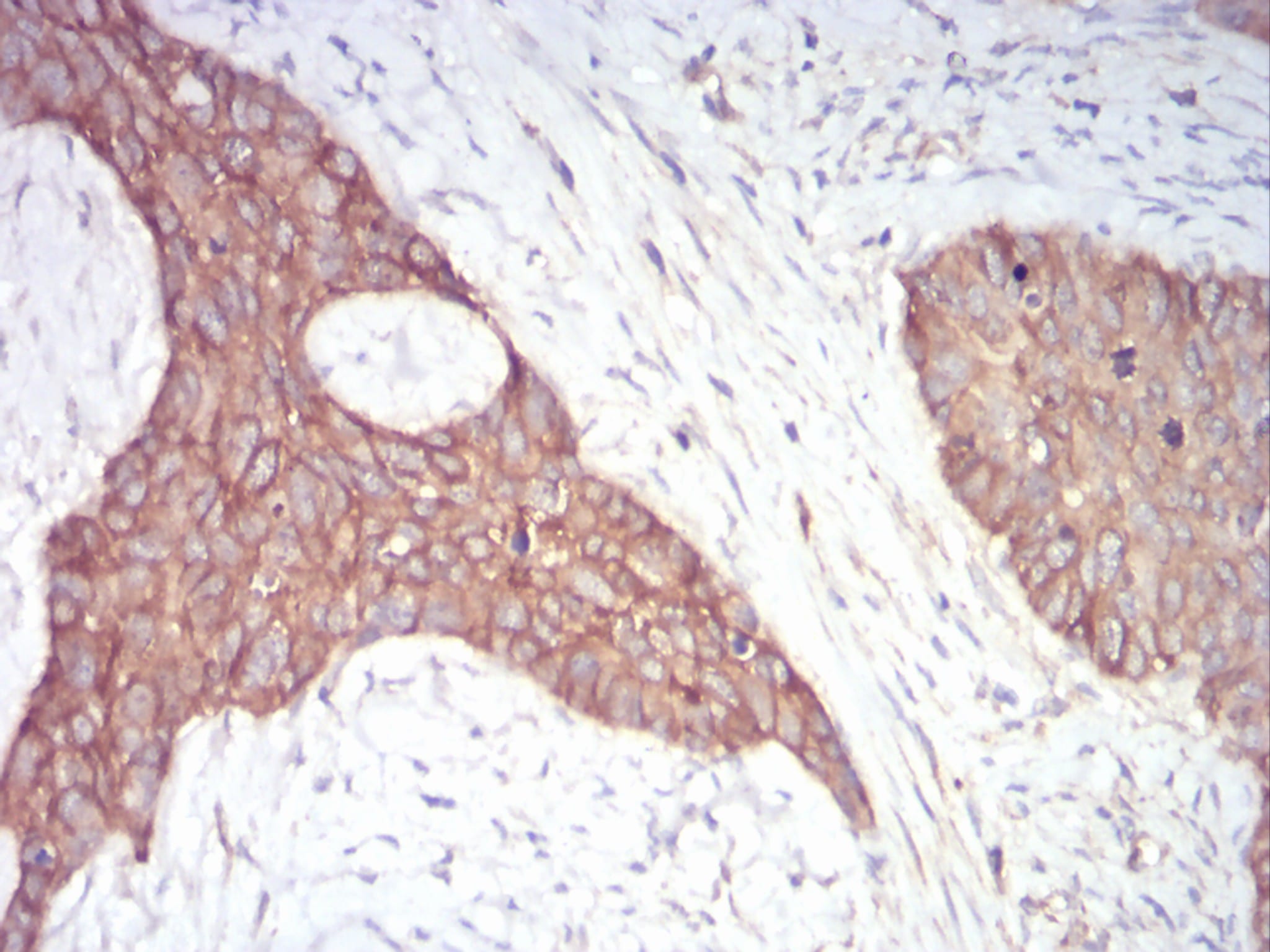 Figure 4:Immunohistochemical analysis of paraffin-embedded cervical cancer tissues using 1-193 mouse mAb with DAB staining.