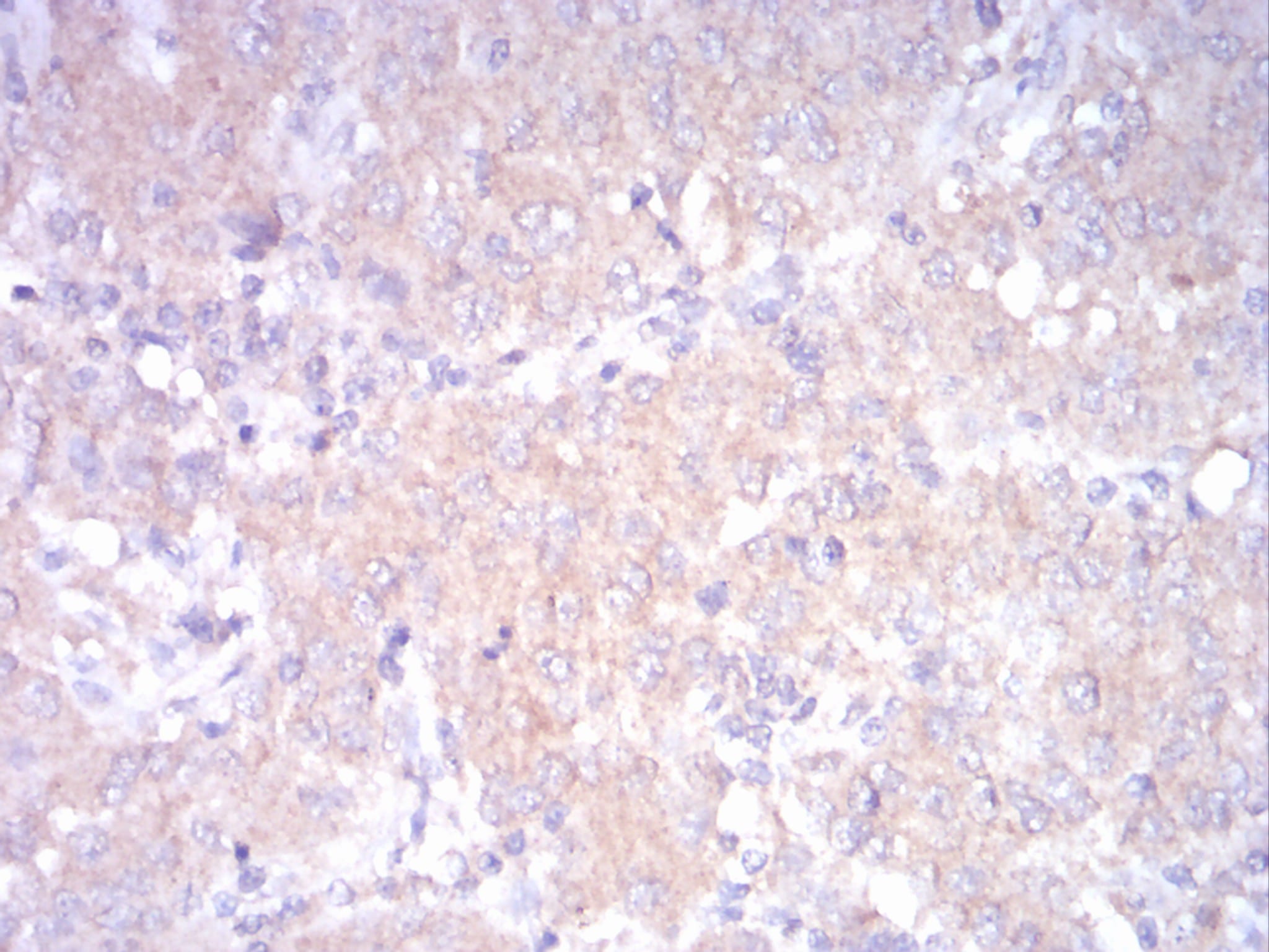 Figure 5:Immunohistochemical analysis of paraffin-embedded ovarian cancertissues using LDLR mouse mAb with DAB staining.