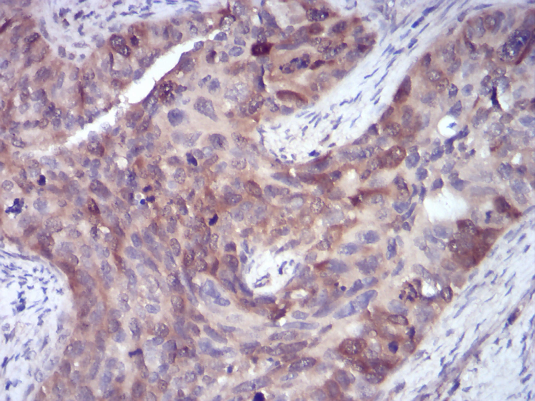 Figure 5:Immunohistochemical analysis of paraffin-embedded cervical cancer tissues using SELL mouse mAb with DAB staining.
