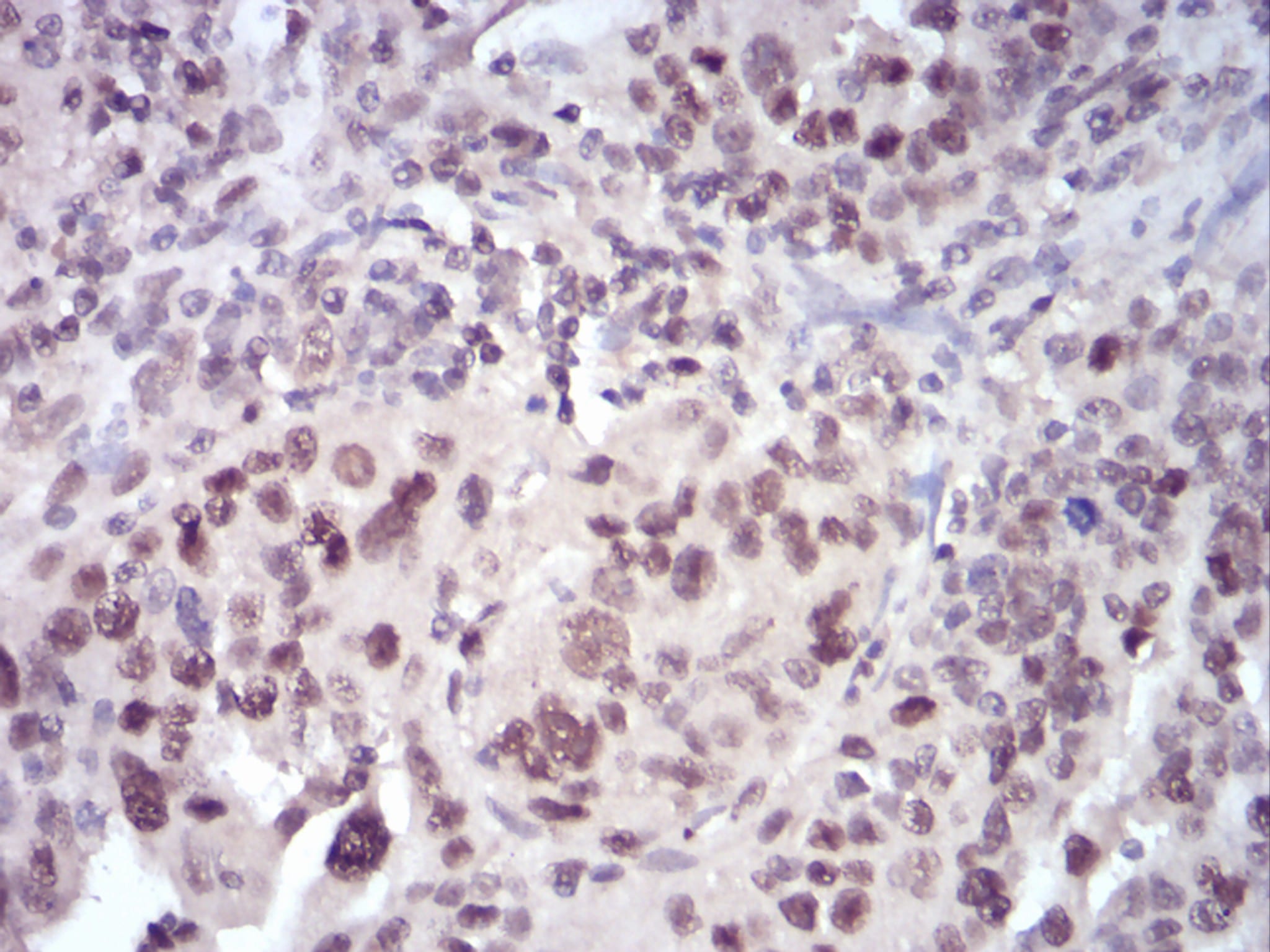 Figure 6:Immunohistochemical analysis of paraffin-embedded ovarian cancer tissues using SELL mouse mAb with DAB staining.