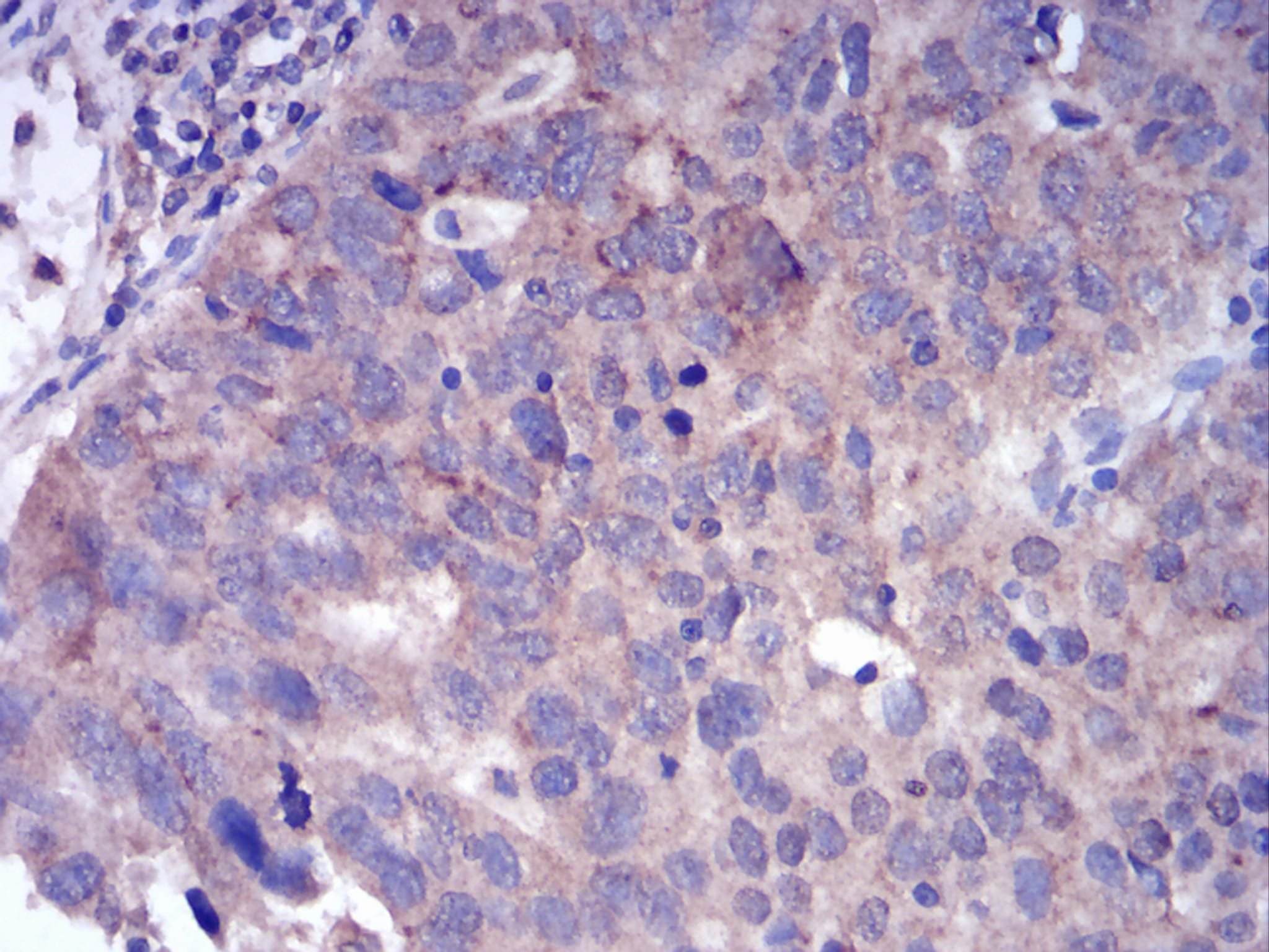 Figure 5:Immunohistochemical analysis of paraffin-embedded ovarian cancer tissues using FGFR3 mouse mAb with DAB staining.