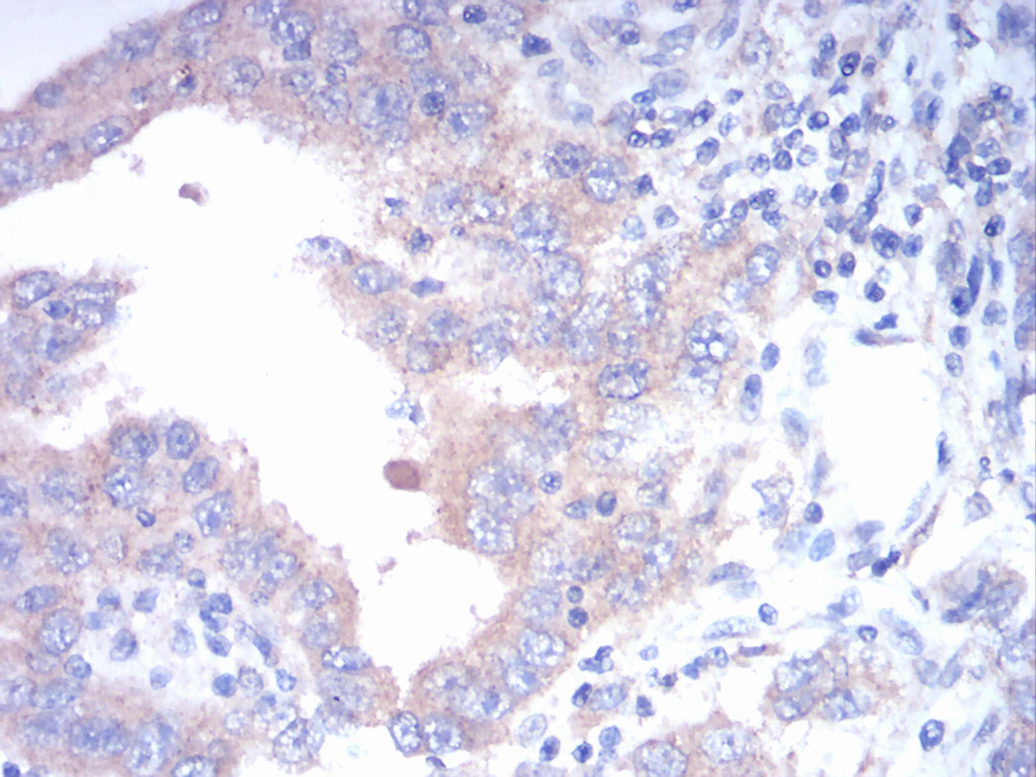 Figure 6:Immunohistochemical analysis of paraffin-embedded endometrial cancer tissues using FGFR3 mouse mAb with DAB staining.