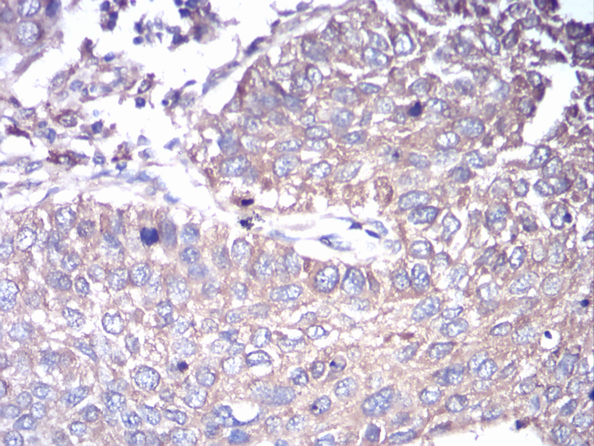 Figure 5:Immunohistochemical analysis of paraffin-embedded lung cancer tissues using GNAS mouse mAb with DAB staining.