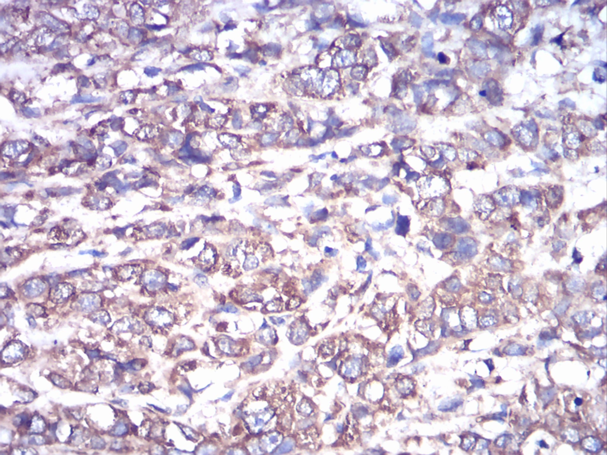 Figure 6:Immunohistochemical analysis of paraffin-embedded breast cancer tissues using GNAS mouse mAb with DAB staining.