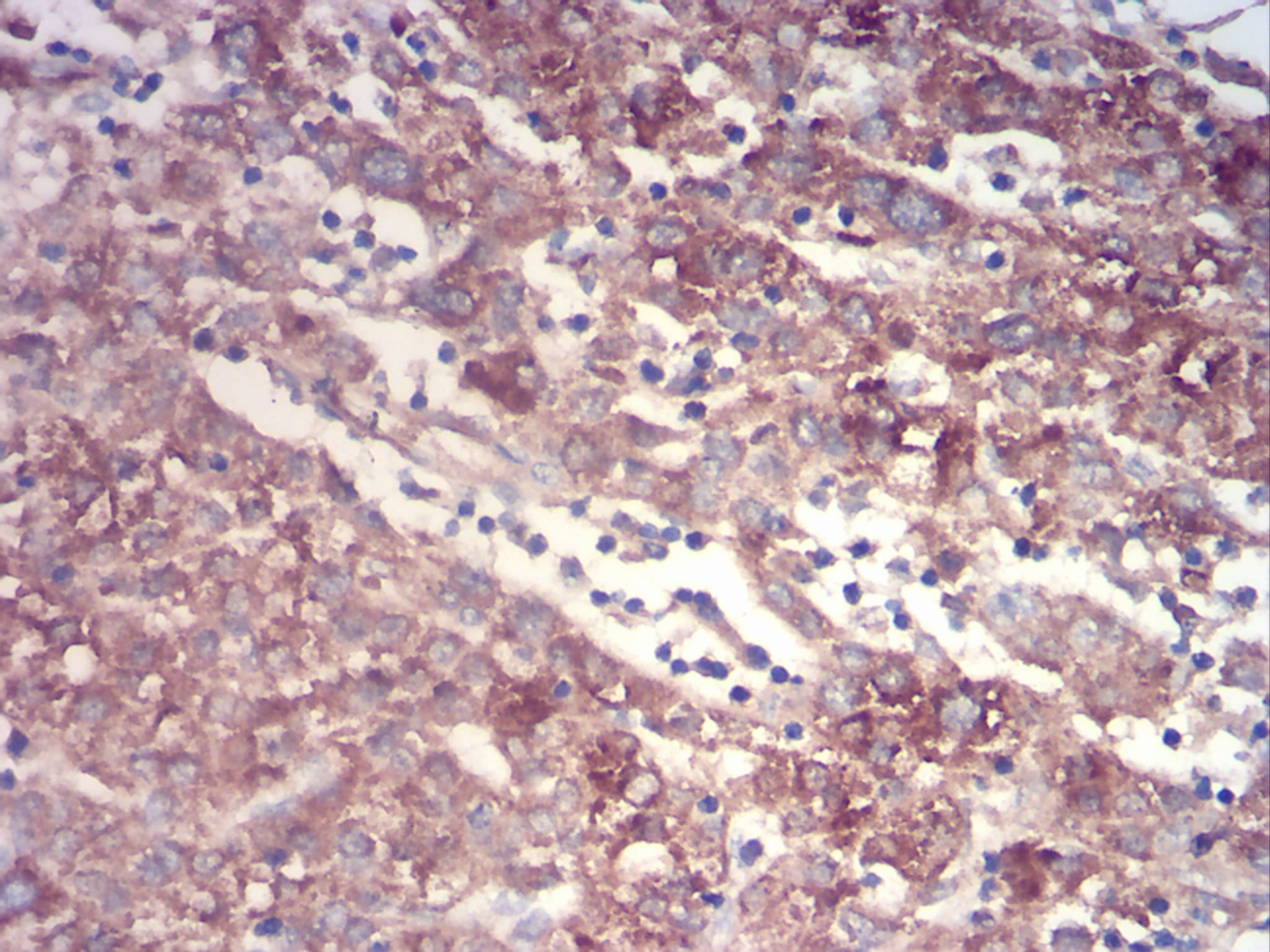 Figure 7:Immunohistochemical analysis of paraffin-embedded liver cancer tissues using TTR mouse mAb with DAB staining.