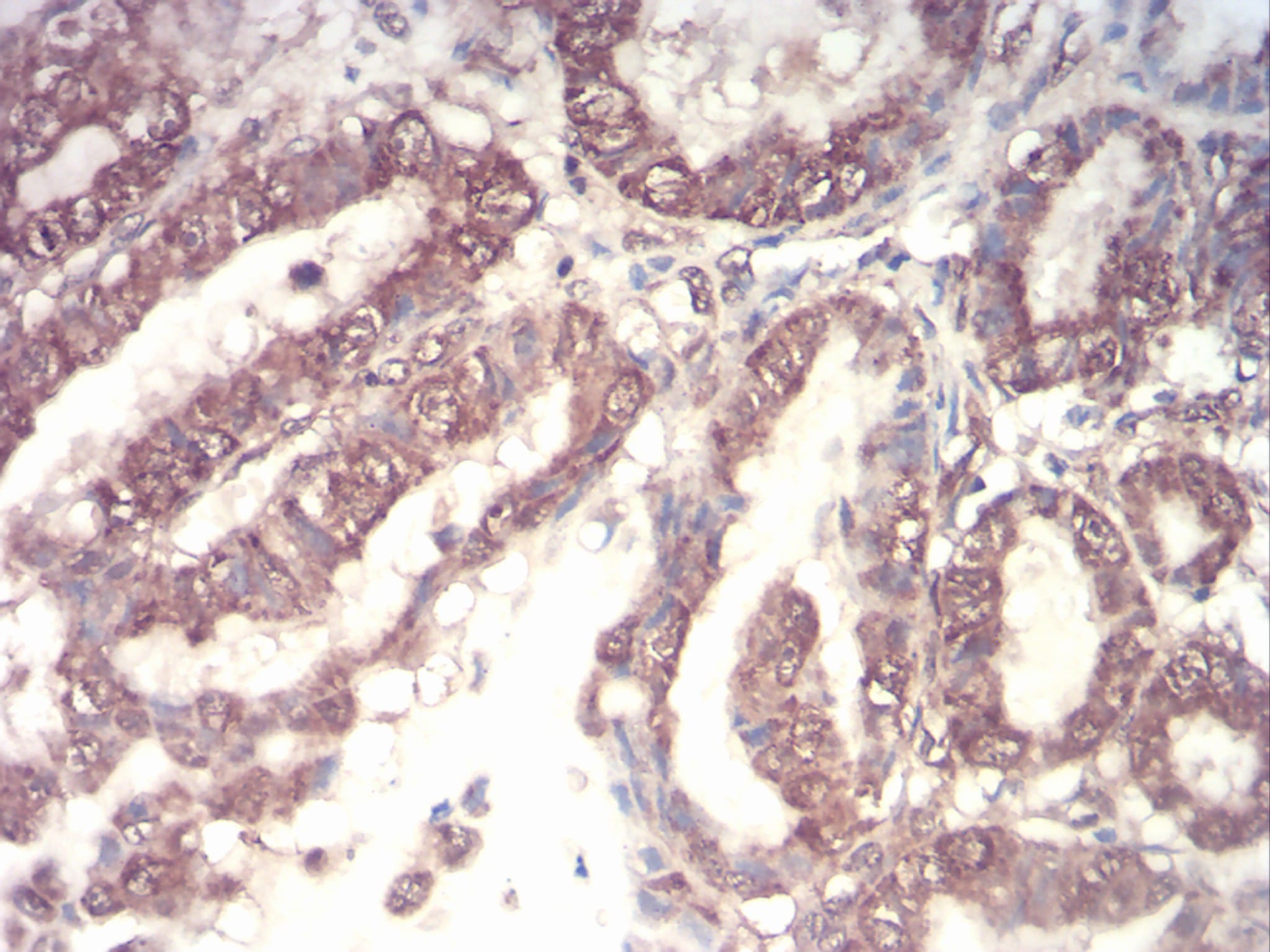 Figure 4:Immunohistochemical analysis of paraffin-embedded esophageal cancer tissues using CSF3 mouse mAb with DAB staining.