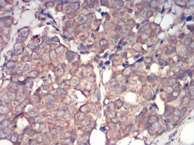 Figure 8:Immunohistochemical analysis of paraffin-embedded breast cancer tissues using IRAK3 mouse mAb with DAB staining.