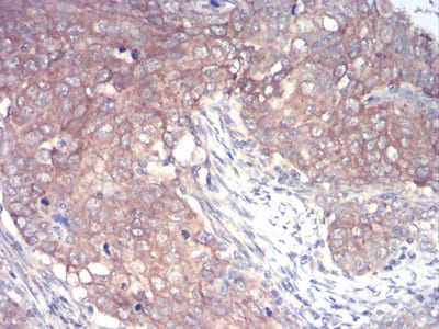 Figure 7:Immunohistochemical analysis of paraffin-embedded cervical cancer tissues using IRAK3 mouse mAb with DAB staining.