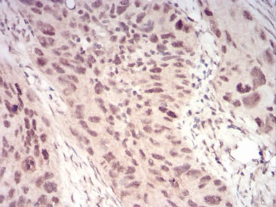 Figure 7:Immunohistochemical analysis of paraffin-embedded cervical cancer tissues using WTAP mouse mAb with DAB staining.