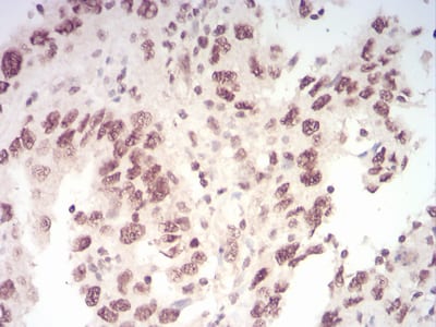 Figure 8:Immunohistochemical analysis of paraffin-embedded endometrial cancer tissues using WTAP mouse mAb with DAB staining.