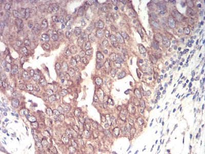Figure 7:Immunohistochemical analysis of paraffin-embedded ovarian cancer tissues using EMD mouse mAb with DAB staining.