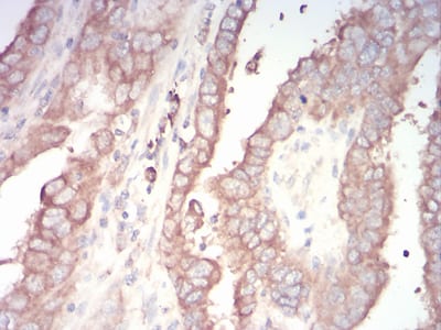 Figure 7:Immunohistochemical analysis of paraffin-embedded TFAP2A tissues using endometrial cancer mouse mAb with DAB staining.