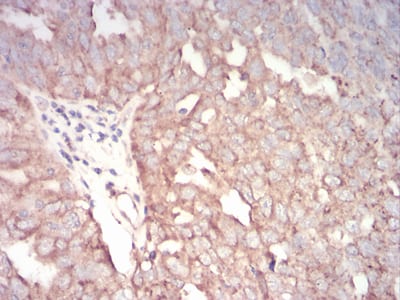 Figure 6:Immunohistochemical analysis of paraffin-embedded ovarian cancer tissues using TFAP2A mouse mAb with DAB staining.