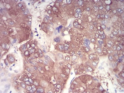 Figure 7:Immunohistochemical analysis of paraffin-embedded liver cancer tissues using NFKBIA mouse mAb with DAB staining.