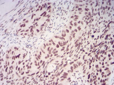 Figure 4:Immunohistochemical analysis of paraffin-embedded cervical cancer tissues using CBX1 mouse mAb with DAB staining.