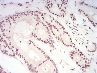 Figure 8:Immunohistochemical analysis of paraffin-embedded colon cancer tissues using CBX1 mouse mAb with DAB staining.