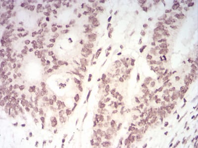 Figure 6:Immunohistochemical analysis of paraffin-embedded rectum cancer tissues using TERT mouse mAb with DAB staining.