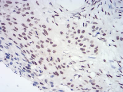 Figure 6:Immunohistochemical analysis of paraffin-embedded esophageal cancer tissues using CBX3 mouse mAb with DAB staining.