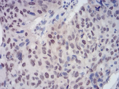 Figure 5:Immunohistochemical analysis of paraffin-embedded ovarian cancer tissues using CBX3 mouse mAb with DAB staining.