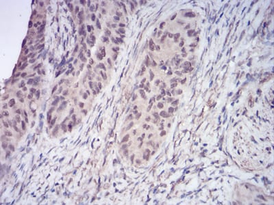 Figure 6:Immunohistochemical analysis of paraffin-embedded cervical cancer tissues using HDAC2 mouse mAb with DAB staining.