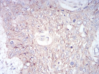 Figure 7:Immunohistochemical analysis of paraffin-embedded esophageal cancer tissues using GLI1 mouse mAb with DAB staining.