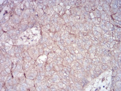 Figure 8:Immunohistochemical analysis of paraffin-embedded bladder cancer tissues using RALA mouse mAb with DAB staining.