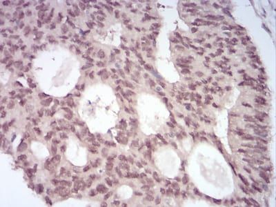 Figure 7:Immunohistochemical analysis of paraffin-embedded rectum cancer tissues using MGMT mouse mAb with DAB staining.