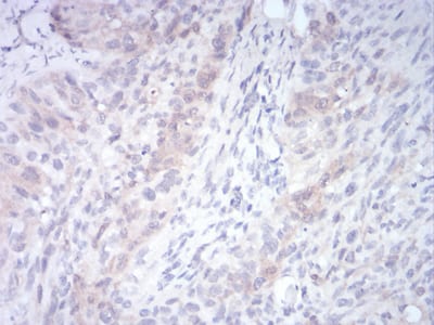 Figure 6:Immunohistochemical analysis of paraffin-embedded cervical cancer tissues using RND3 mouse mAb with DAB staining.