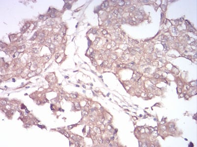 Figure 6:Immunohistochemical analysis of paraffin-embedded ovarian cancer tissues using Rab13 mouse mAb with DAB staining.