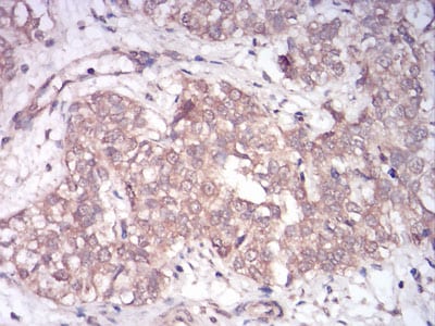 Figure 7:Immunohistochemical analysis of paraffin-embedded bladder cancer tissues using Rab13 mouse mAb with DAB staining.